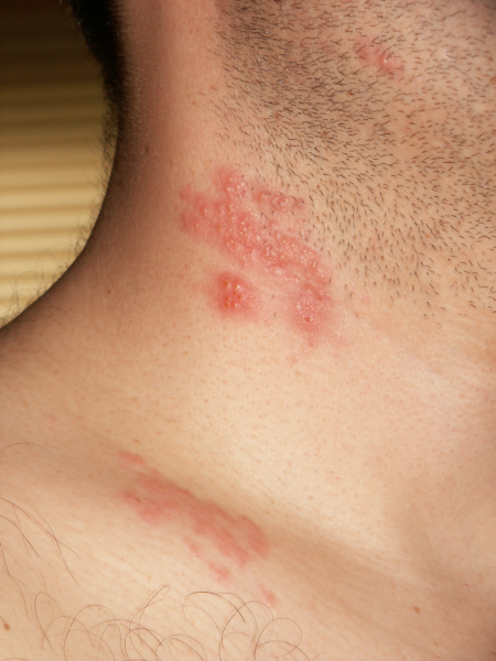 Arquivo:Herpesdorpaginasetefotodois27Foto herpes.png