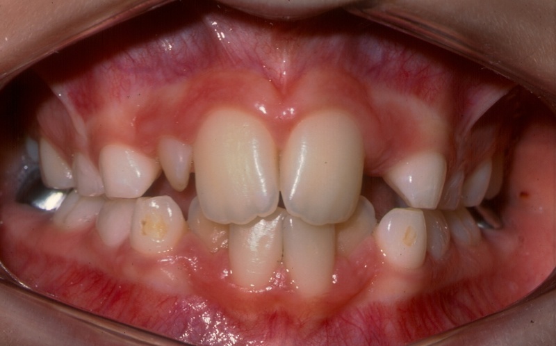 Arquivo:PaginatresfotodoisdenteumDente 1.JPG