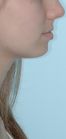 A infância é o melhor tempo para conquistar a harmonia facial. O crescimento harmônico entre as arcadas e um perfil reto é o objetivo. Créditos: Arquivo Estela
