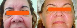 Diferença a olhos vistos Créditos: Arquivo Vitacare
