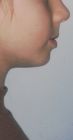 A infância é o melhor tempo para conquistar a harmonia facial. O crescimento harmônico entre as arcadas e um perfil reto é o objetivo. Créditos: Arquivo Estela